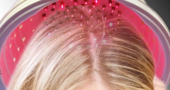 Laserbehandling mod hårtab (hårlaser)